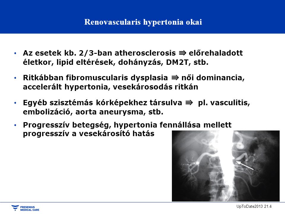 Jegyzetek medikusoknak/Nephrologia/Chronicus vascularis vesebetegségek – Wikikönyvek